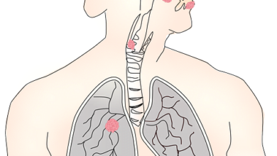 Treating Malnutrition Should Be Priority for Cancer Patients