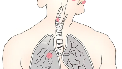 Treating Malnutrition Should Be Priority for Cancer Patients